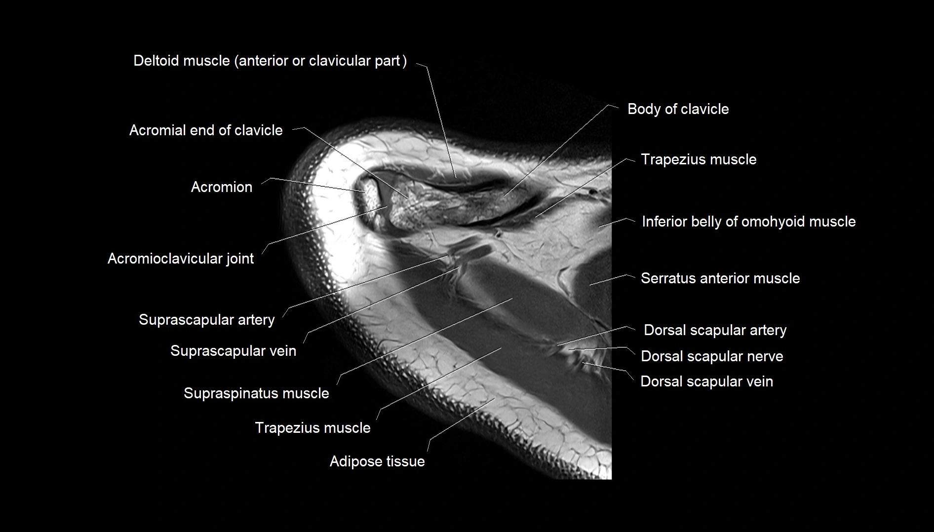 Shoulder cross sectional anatomy MRI 3T axial image 6.webp